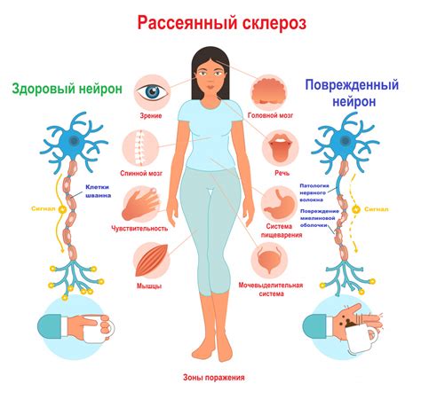 Рассеянный склероз и его симптомы