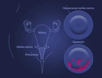Рассматриваем симптомы цервицита