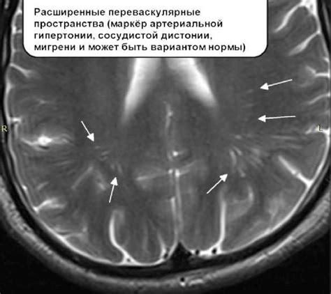 Расширение периваскулярного пространства Вирхова-Робина: тесная связь и взаимоотношение