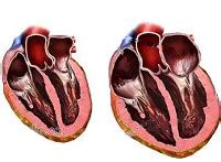 Расширение сердца: причины и симптомы