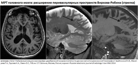 Расширенные периваскулярные пространства Вирхова-Робина: суть и роль в организме