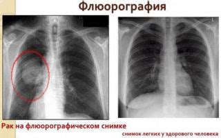 Расшифровка результатов флюорографии сердца и возможные причины изменений