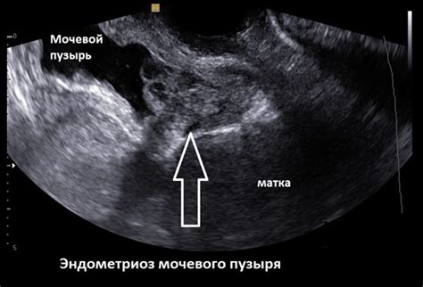 Расшифровка эхографических признаков внутреннего эндометриоза