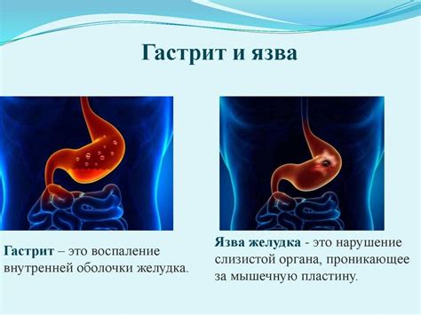 Рвота и тошнота: основные признаки простуды желудка