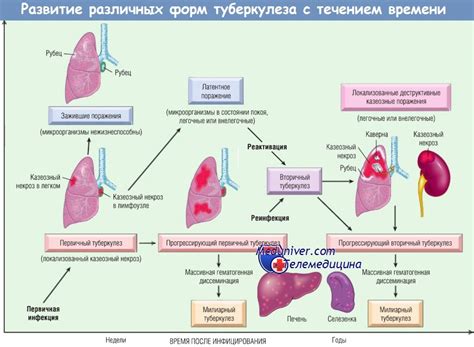 Реабилитация и восстановление после лечения локальной формы туберкулеза