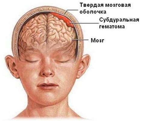 Реабилитация после ушиба головного мозга