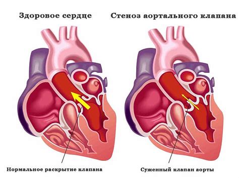 Регургитация аортального клапана