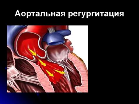 Регургитация аортального клапана и беременность: особенности и рекомендации