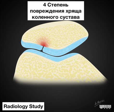 Рекомендации по профилактике хондромаляции коленного сустава 3 степени