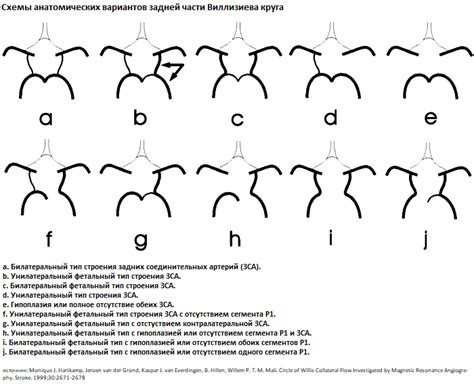 Реконструкция виллизиева круга: варианты восстановления
