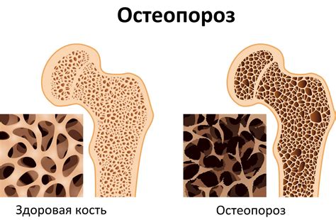 Реминерализация и остеопороз