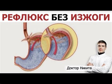 Рефлюкс кислоты из желудка в пищевод