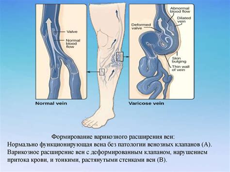 Риск возникновения варикозной болезни