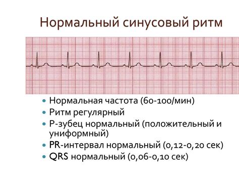 Ритм синусовый на ЭКГ: что это означает?