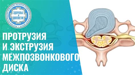 Роликовая экструзия и проблемы насыщенности