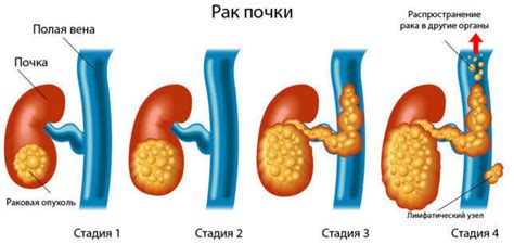 Роль пятилетней выживаемости в диагностике и прогнозе рака почки