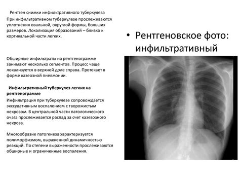 Роль рентгена в диагностике легочных заболеваний