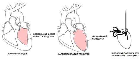 Роль стресса в возникновении сердечных болей