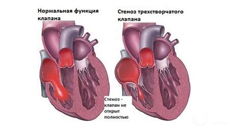 Роль трикуспидального клапана в сердечном кровообращении