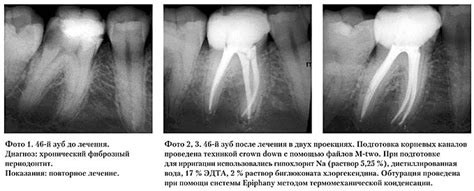 Светлые корни на рентгеновском снимке: возможные причины