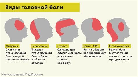 Связь повышенного уровня прогестерона с возникновением головных болей и мигрени