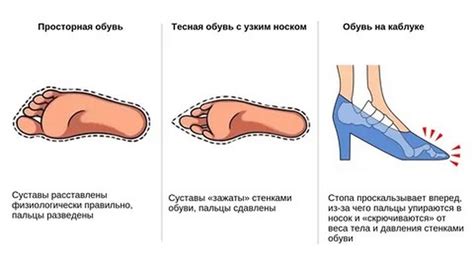 Сдавление нервов при неправильной обуви