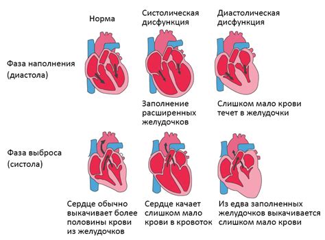 Сердечная недостаточность