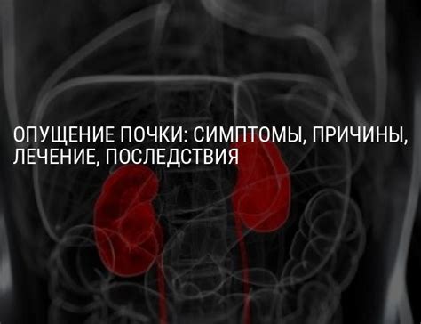 Серьезные последствия нефроптоза 3 степени