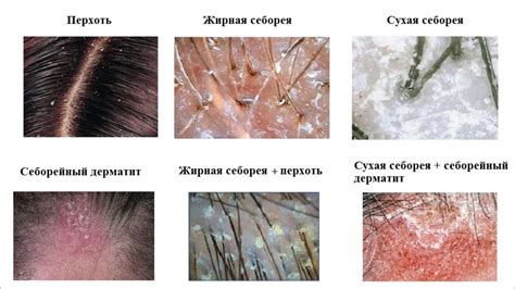 Символическое значение тщательного устранения проблемы с перхотью на голове: какой смысл несет этот сон?