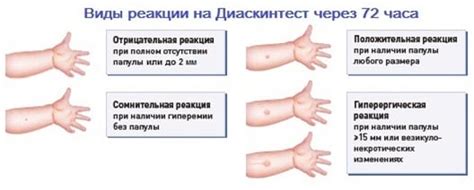 Симптомы, указывающие на положительный результат диаскинтеста