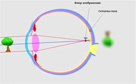 Симптомы близорукости и как их обнаружить