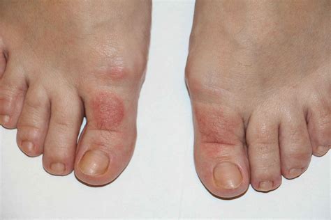 Симптомы болезней, приводящих к болям в больших пальцах на ногах