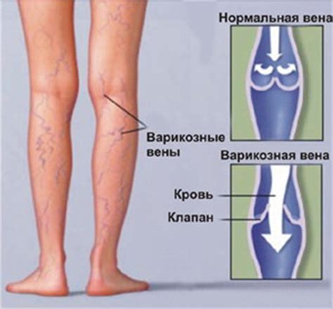 Симптомы боли в ногах