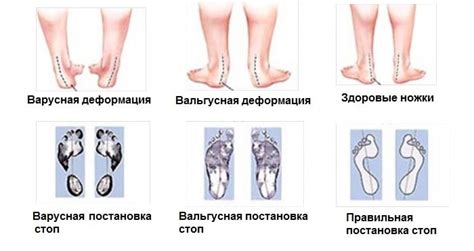 Симптомы варусной стопы