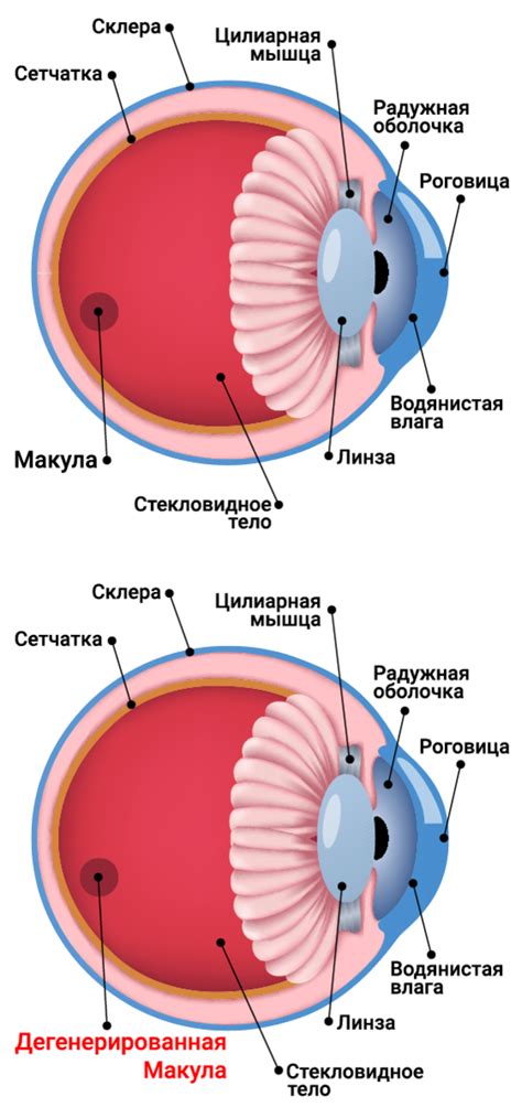 Симптомы влажной макулодистрофии сетчатки