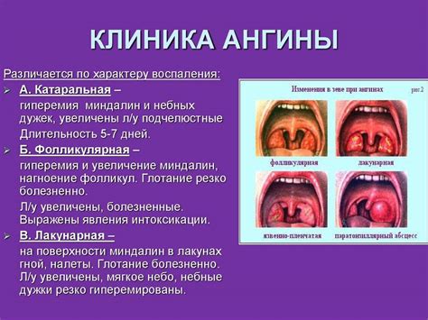 Симптомы воспаления горла и гнойников