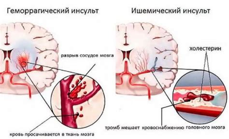 Симптомы геморрагического инсульта