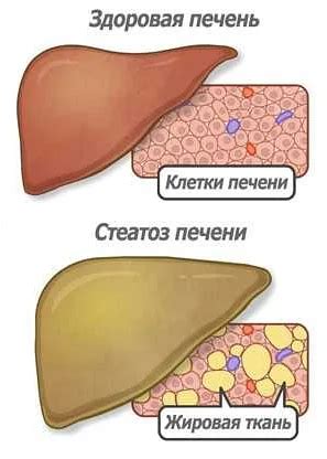 Симптомы гепатоспленомегалии