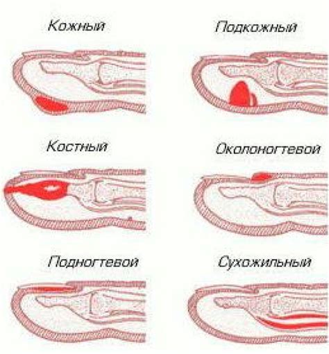 Симптомы гноя на пальце