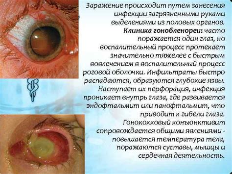 Симптомы гонококковой инфекции и ее последствия