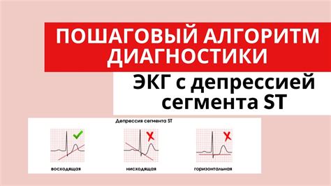 Симптомы горизонтальной депрессии ст-сегмента