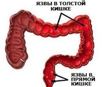 Симптомы гормонорезистентности при няк