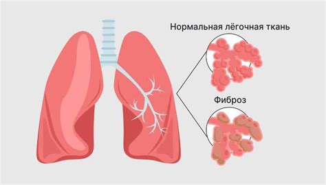 Симптомы грубого фиброза легких