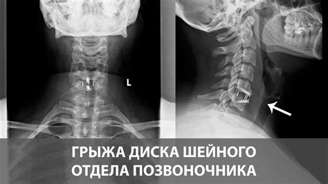 Симптомы грыжи и протрузии шейного отдела