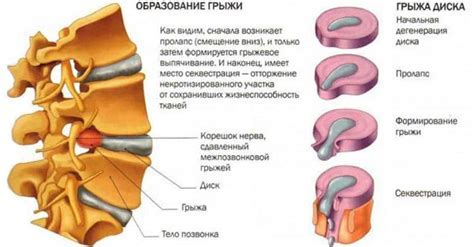 Симптомы грыжи с секвестром