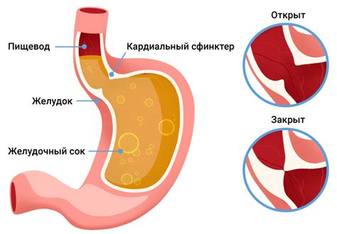 Симптомы гэрб неэрозивной формы