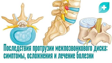 Симптомы дорзальной диффузной протрузии межпозвонкового диска