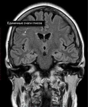 Симптомы единичных очагов глиоза