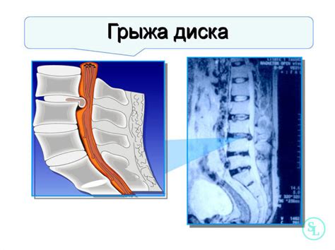 Симптомы защемления мышцы