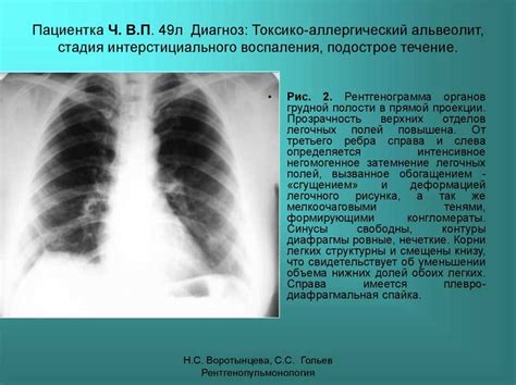 Симптомы инфильтрации легочного рисунка